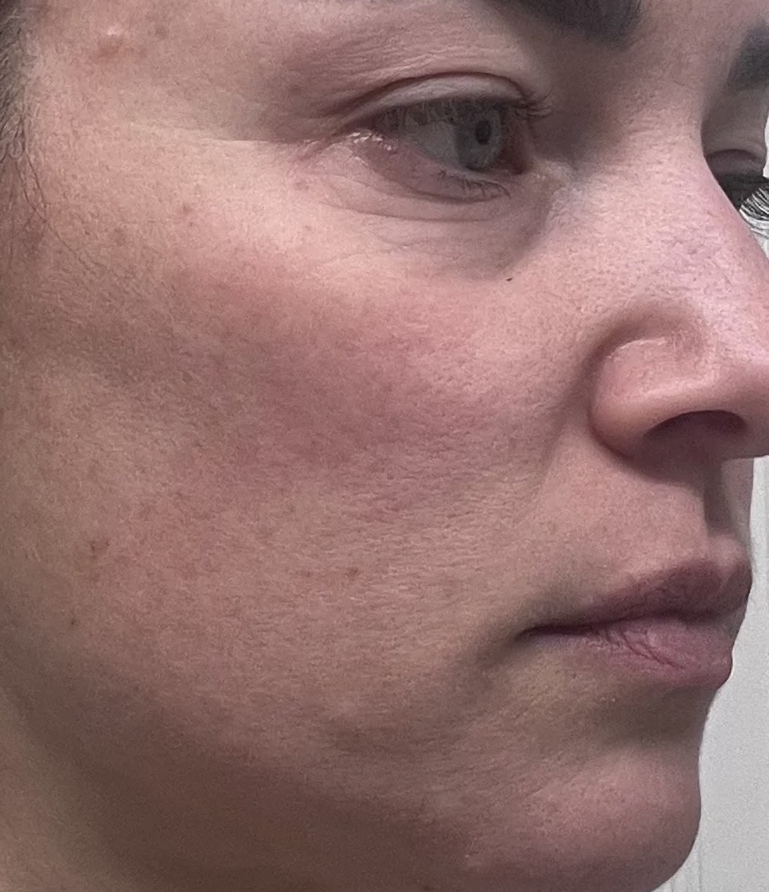Close-up of a person's eye with redness and irritation on the surrounding skin.