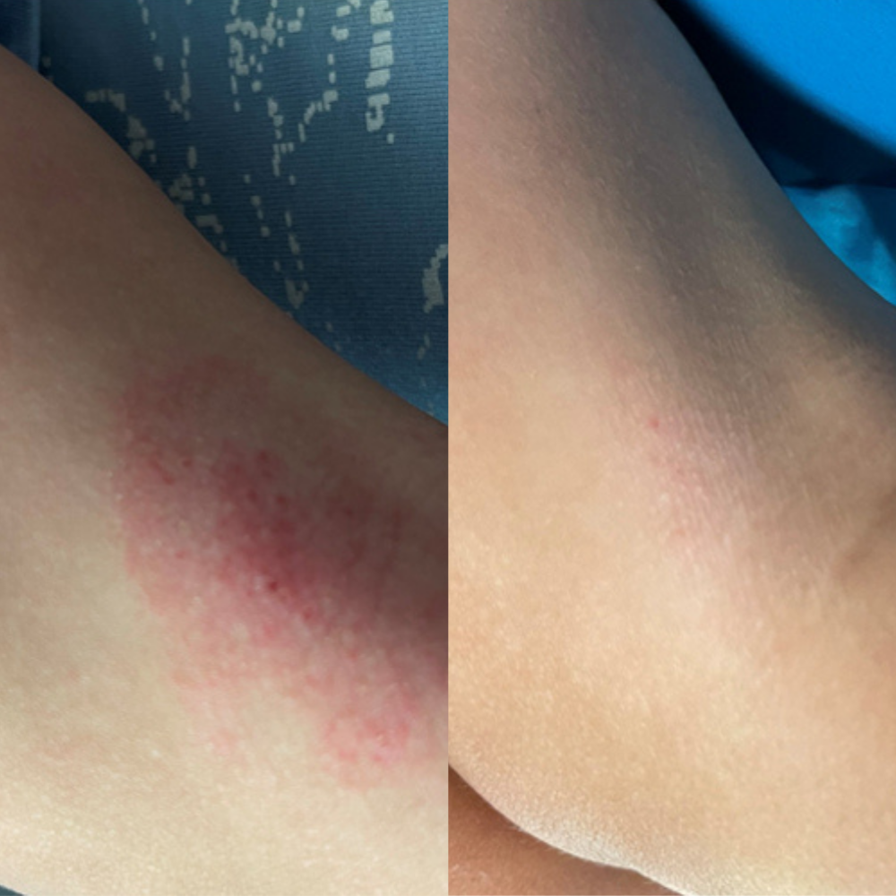 A side-by-side comparison of a red skin rash on an arm before and after healing.