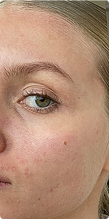 A close-up of a woman's face showing her right green eye, eyebrow, and cheek with some redness.