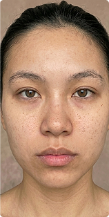 A close-up, frontal photograph of a person's face with a neutral expression, showing some freckles and skin texture.
