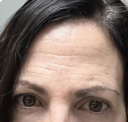 Close-up of a person's forehead and eyes with dark hair.