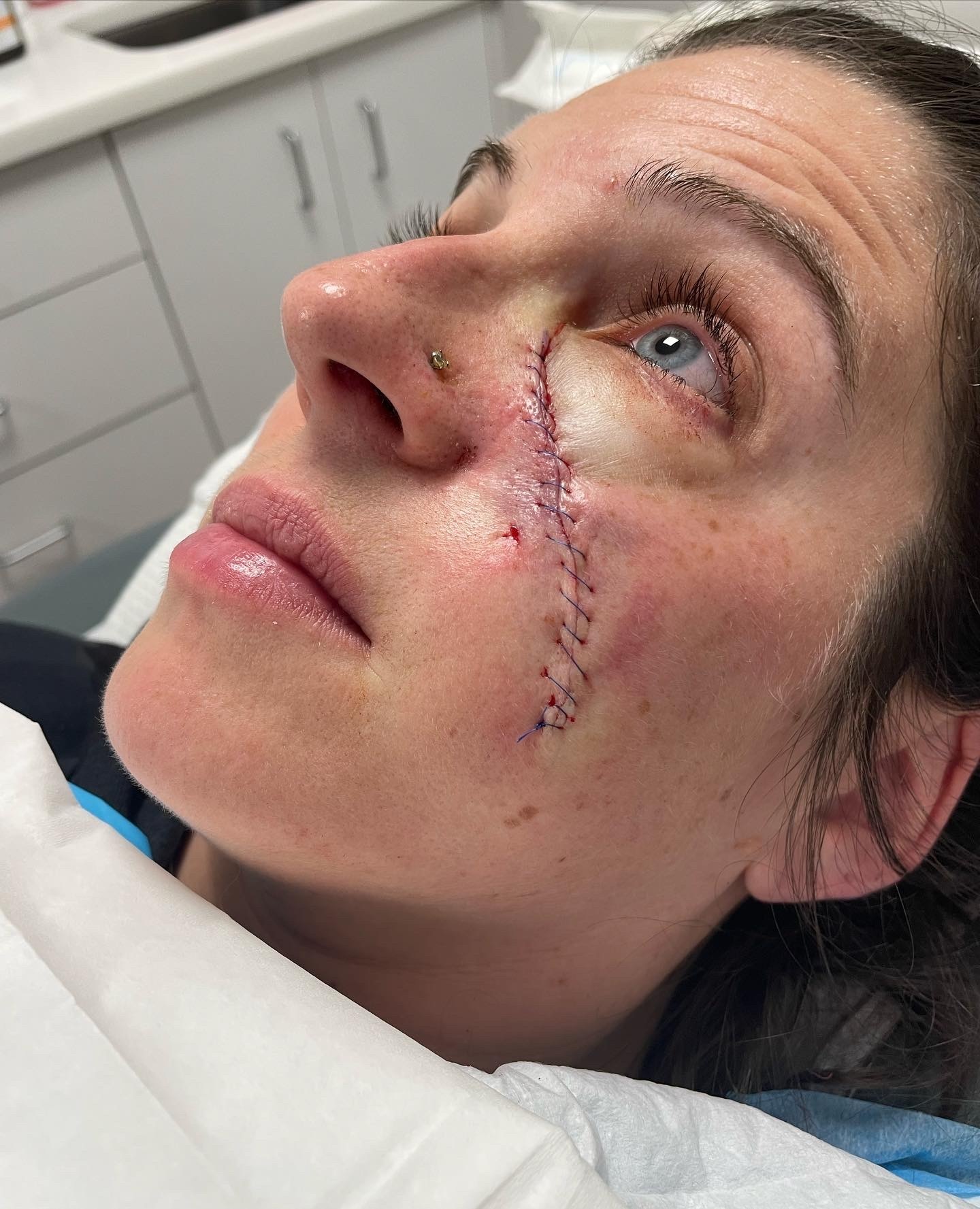 Person with facial stitches lying on a medical bed.