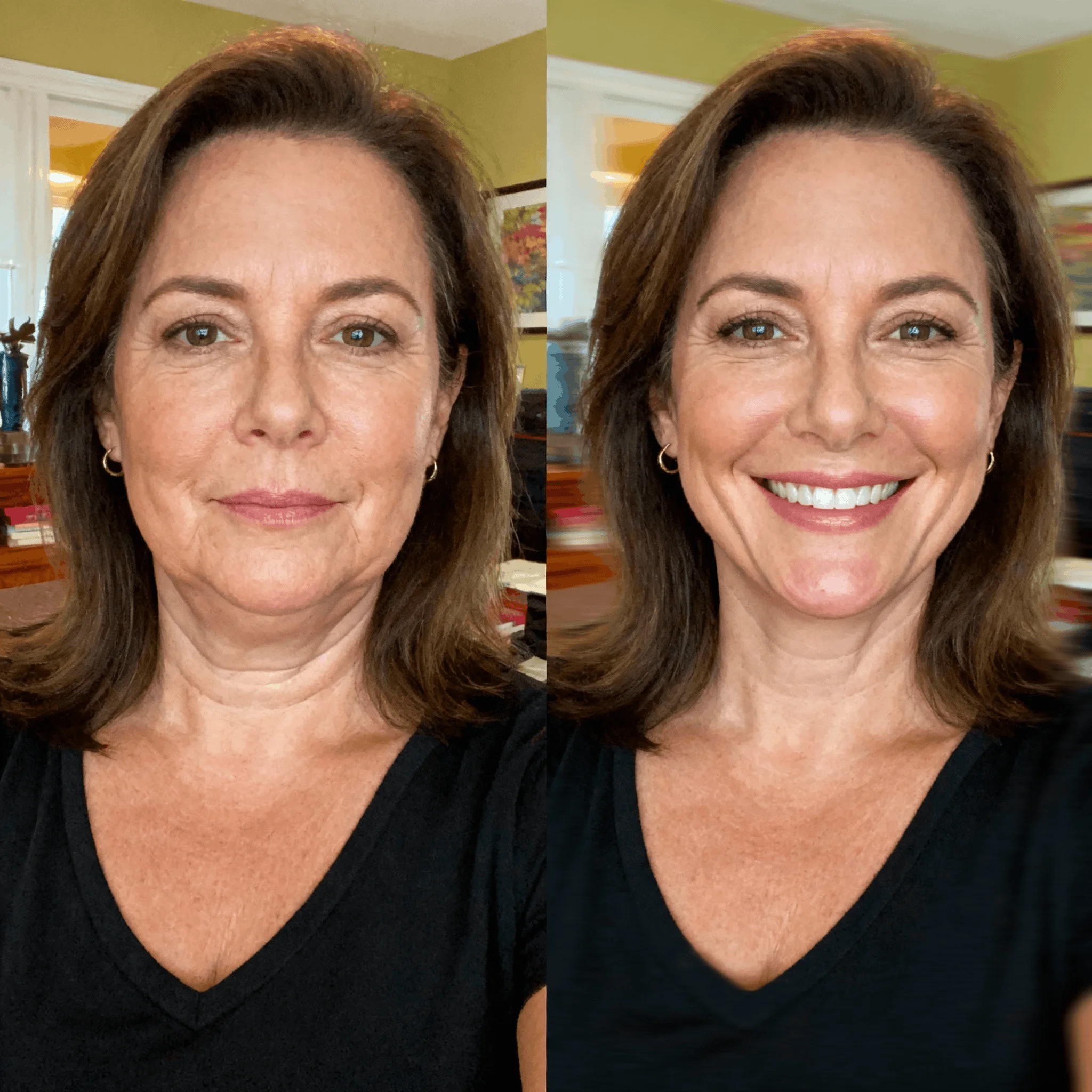 A before and after comparison of a woman's face, showing her smiling and looking younger on the right.