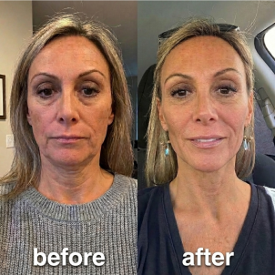 A before and after comparison image of a woman's face showing a reduction in wrinkles and improved skin tone.
