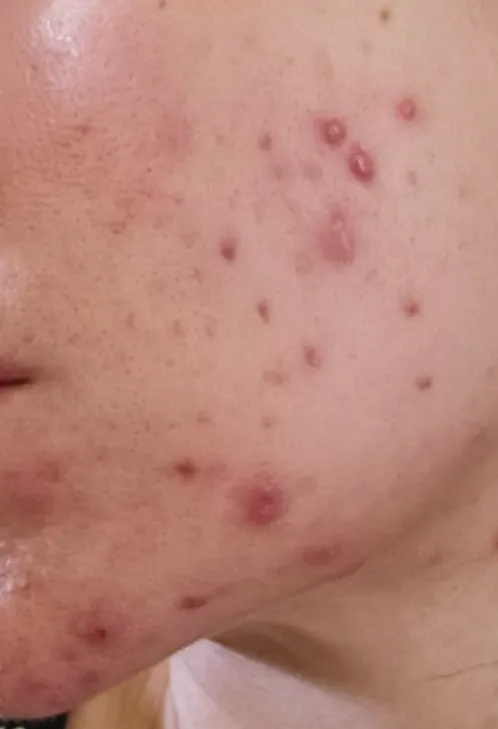 Close-up of a person's cheek showing numerous red acne blemishes and pimples, conveying a sense of irritation and skin inflammation.