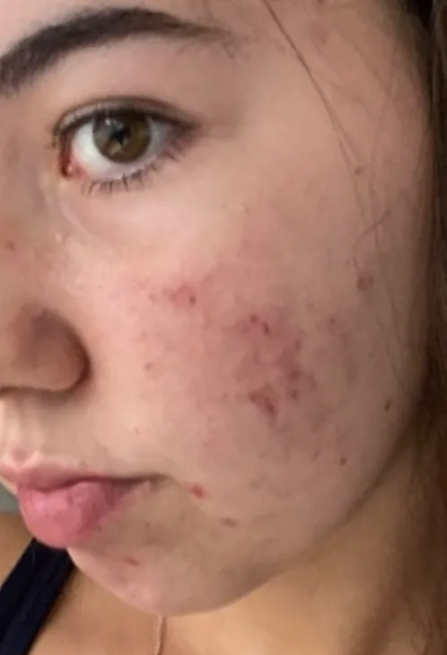 Close-up of a person's face showing mild acne on the cheek. The skin appears slightly inflamed with small red blemishes and a focused expression.