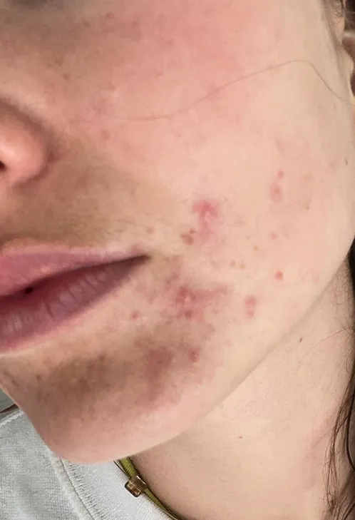 Close-up of a person's cheek highlighting acne. The skin shows redness and several pimples, conveying a focus on skincare issues and concerns.