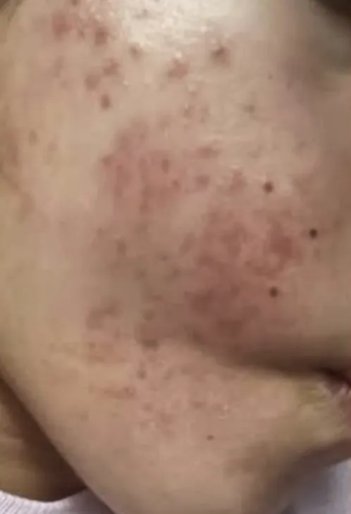 Close-up of a person's cheek showing red, inflamed acne and dark spots on light skin. The image focuses on skin texture and visible blemishes.