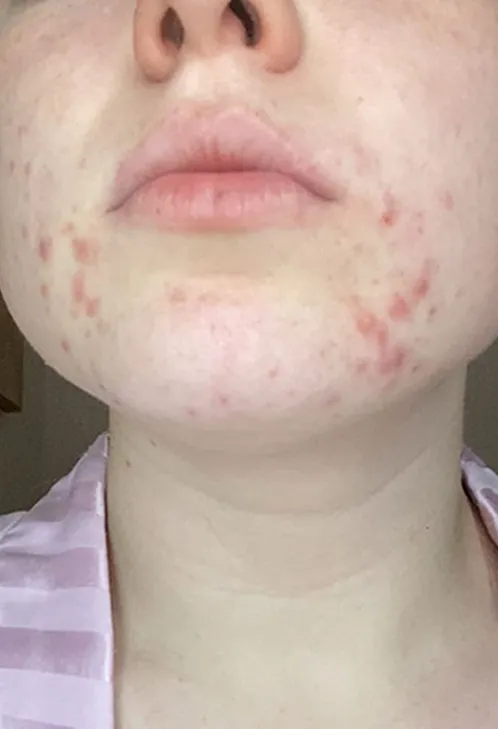 Close-up of the lower half of a face with visible redness and acne on the cheeks and chin. The person wears a light pink striped garment. The image conveys a neutral tone.