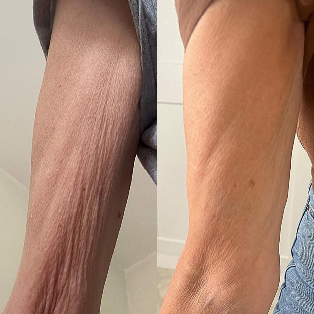 A side-by-side comparison of an arm, showing a reduction in wrinkled skin.