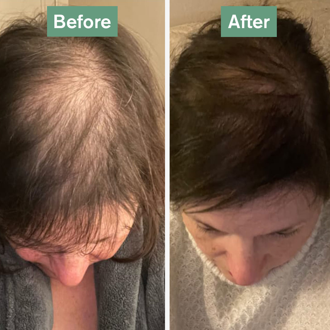 Before and after photos showing hair growth improvement on the top of a person's head.
