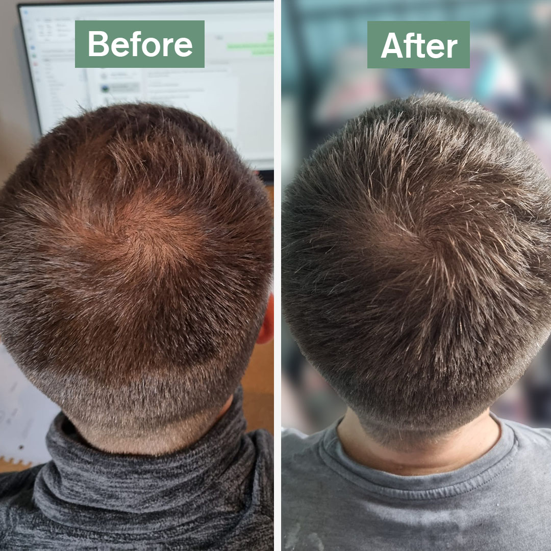 Side-by-side photos of a man's head showing hair growth improvement.