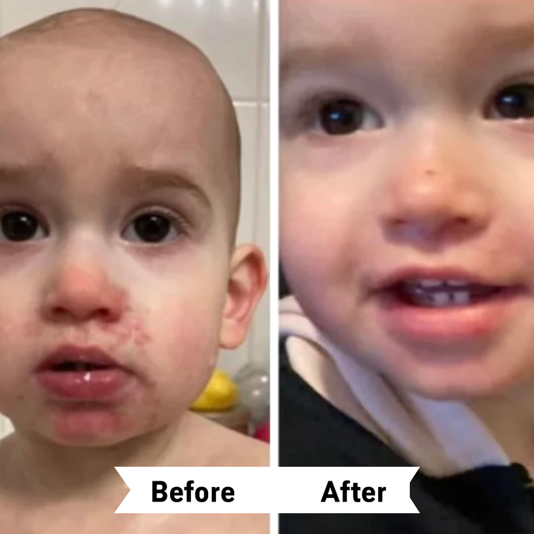 Side-by-side comparison of a woman's face before and after skincare treatment.
