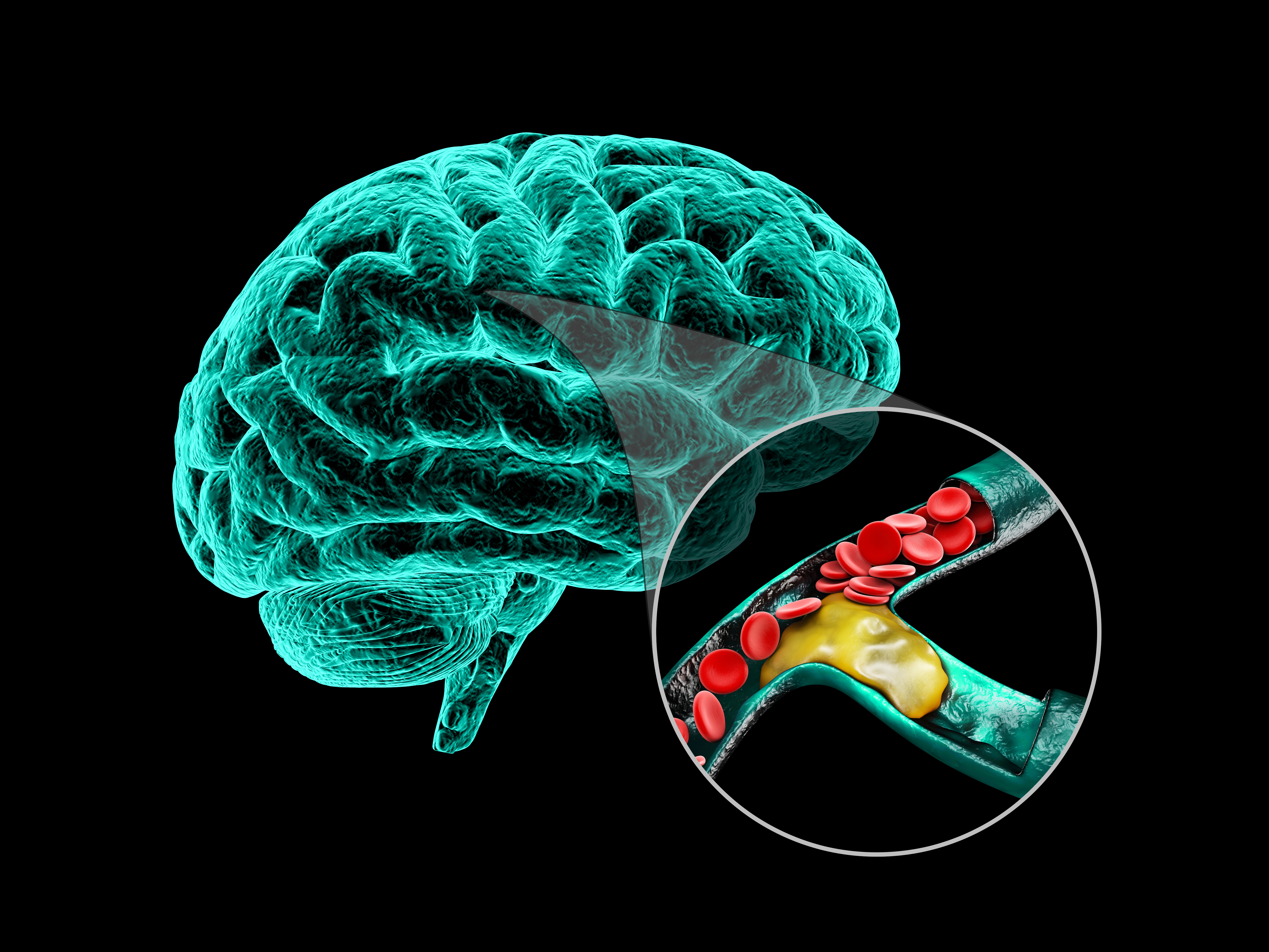 An illustration of waves from a smartphone affecting a person's brain.