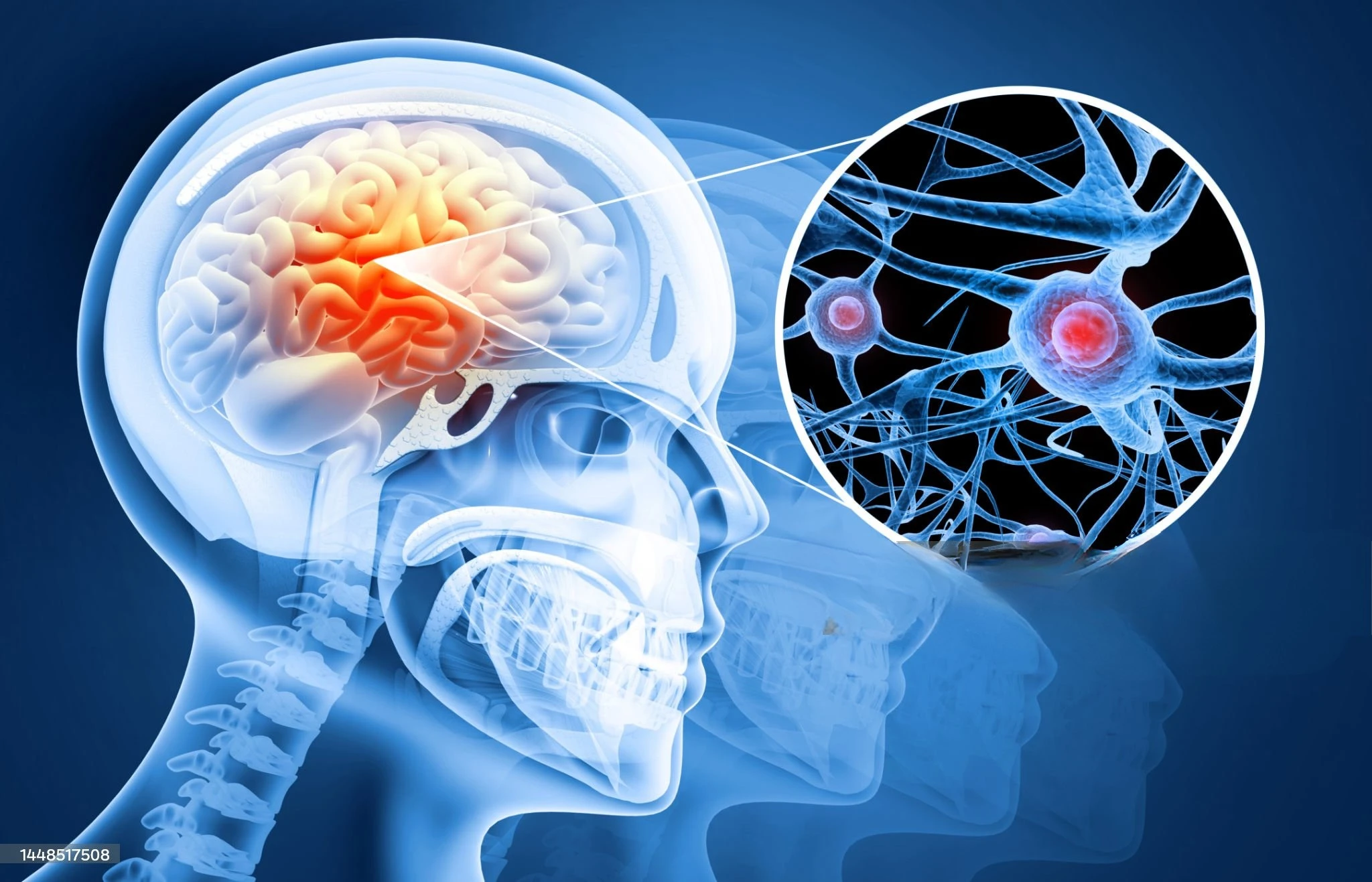A medical illustration showing a human head and brain, with a magnified view of neurons.