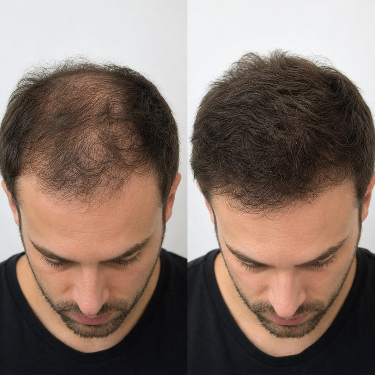 A split image showing the top of a man's head, with thinning hair on the left and fuller hair on the right.
