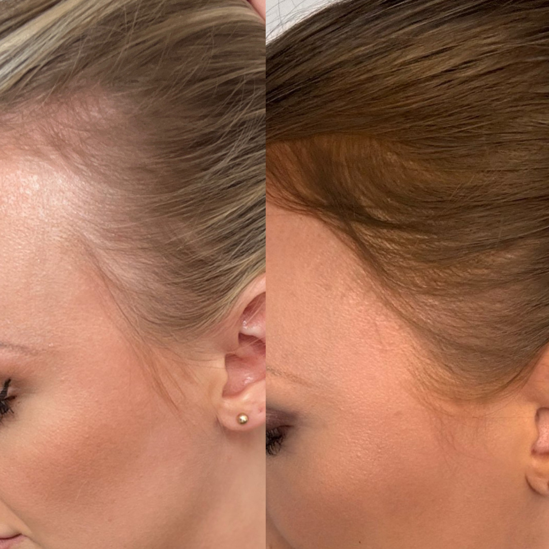 A before-and-after split image showing a woman's hairline, appearing fuller and darker on the right side.