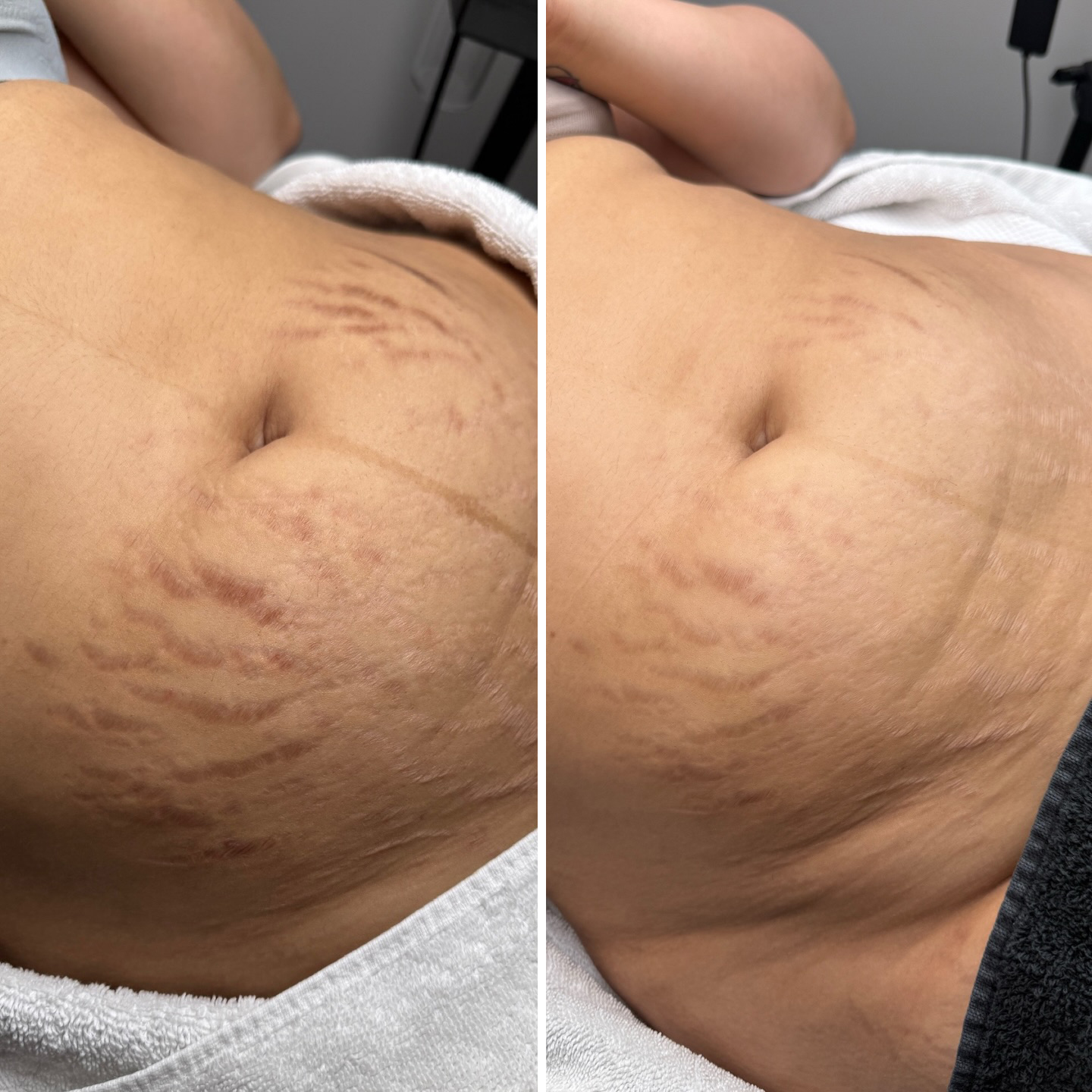 Before and after images of a person's stomach, showing a reduction in the visibility of stretch marks.