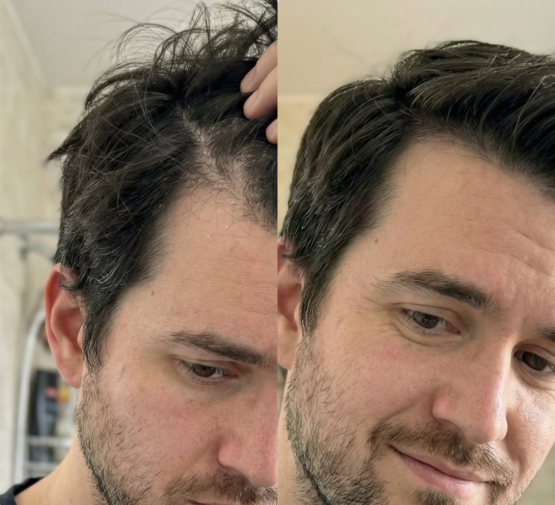 A split image showing a man's thinning hairline on the left and a fuller hairline on the right.