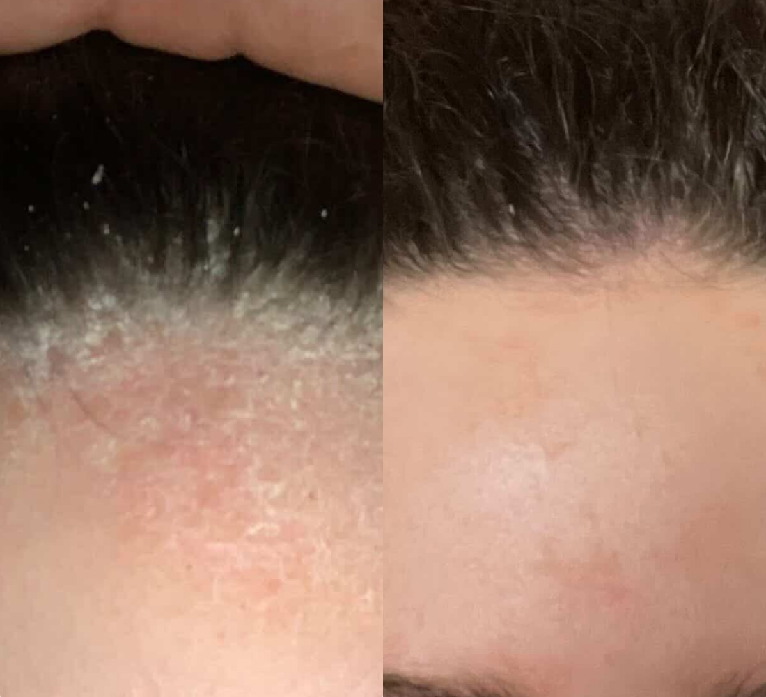 A before and after comparison of a hairline with significant flaking on the left and a clear hairline on the right.