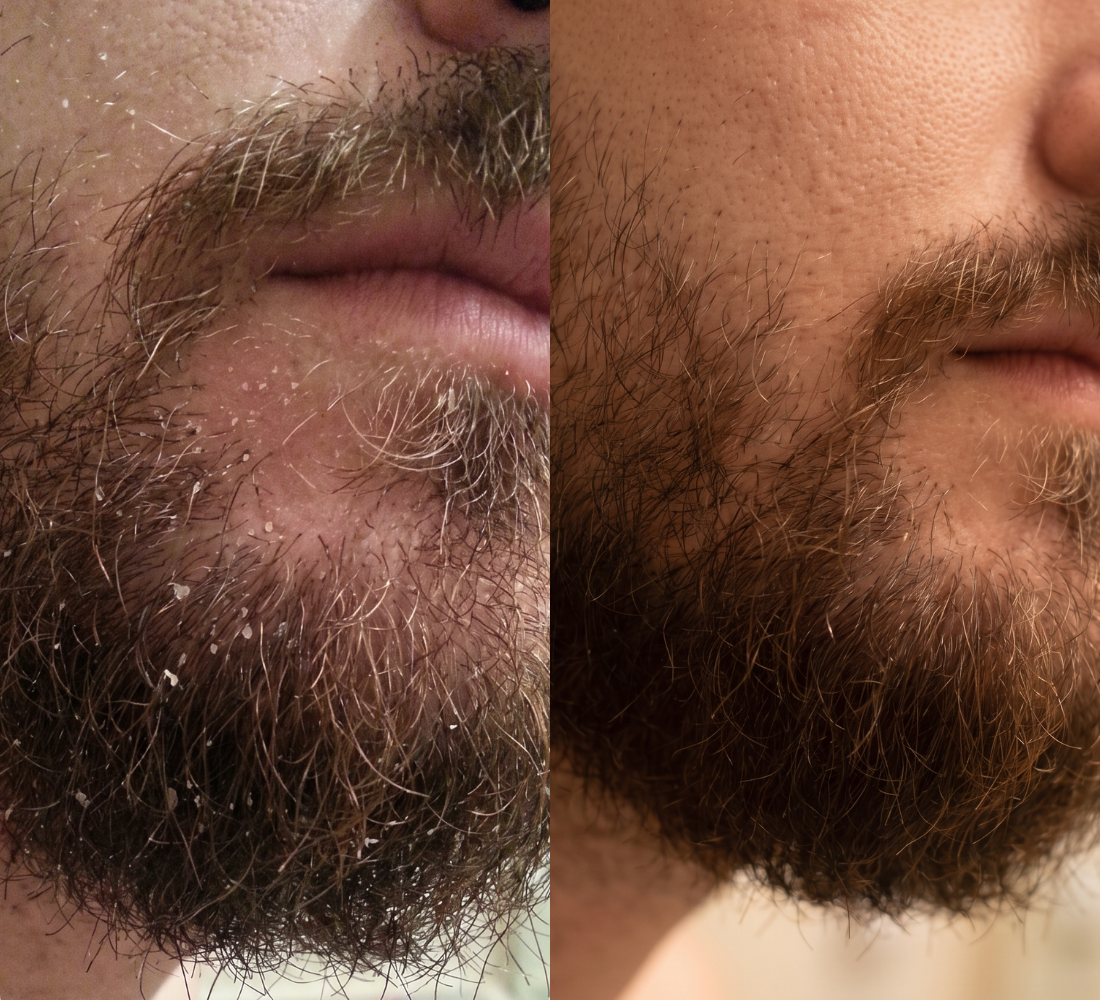 A before and after comparison of a man's beard with dandruff on the left and clean on the right.