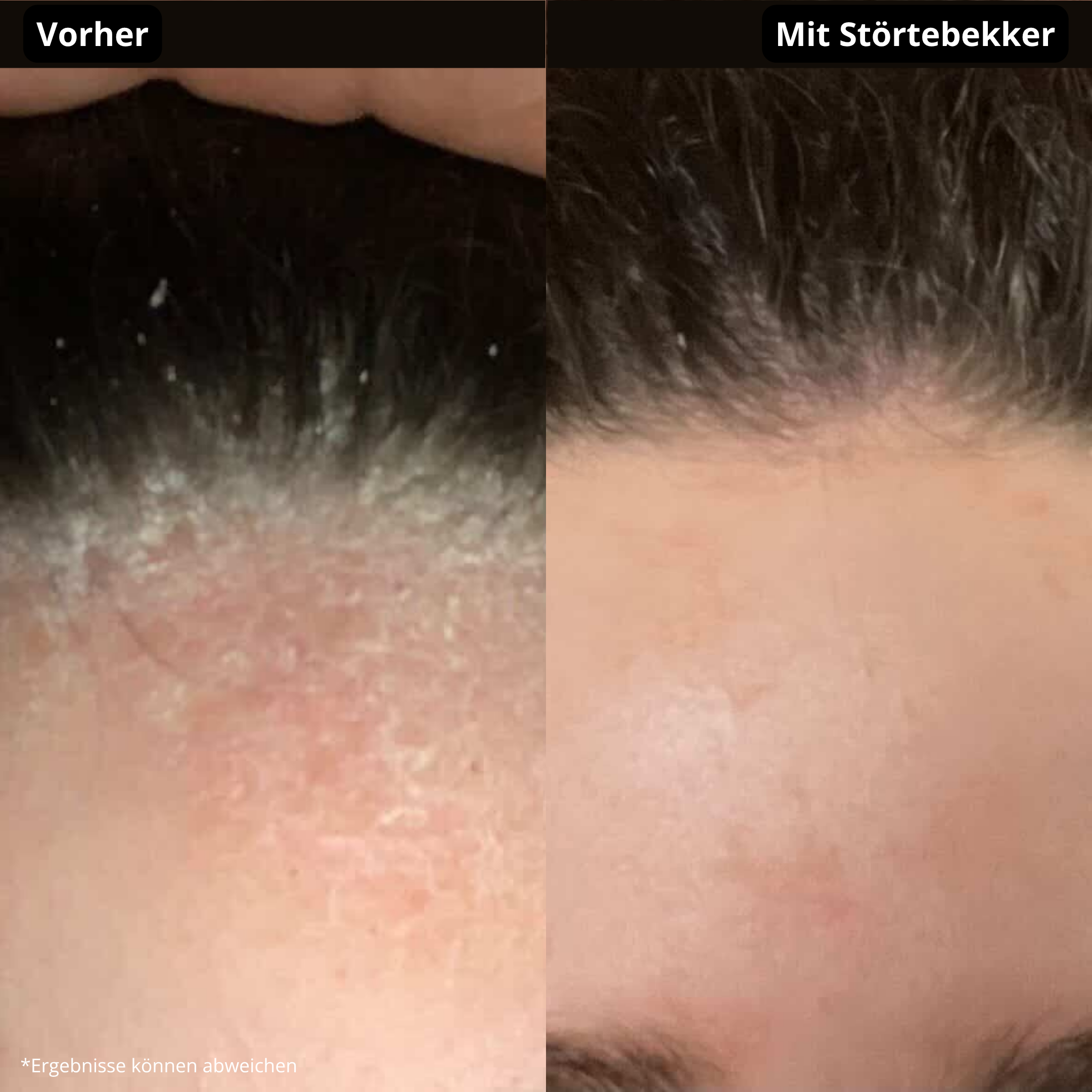 A before-and-after image showing a reduction of dandruff and flaky skin along a person's hairline.