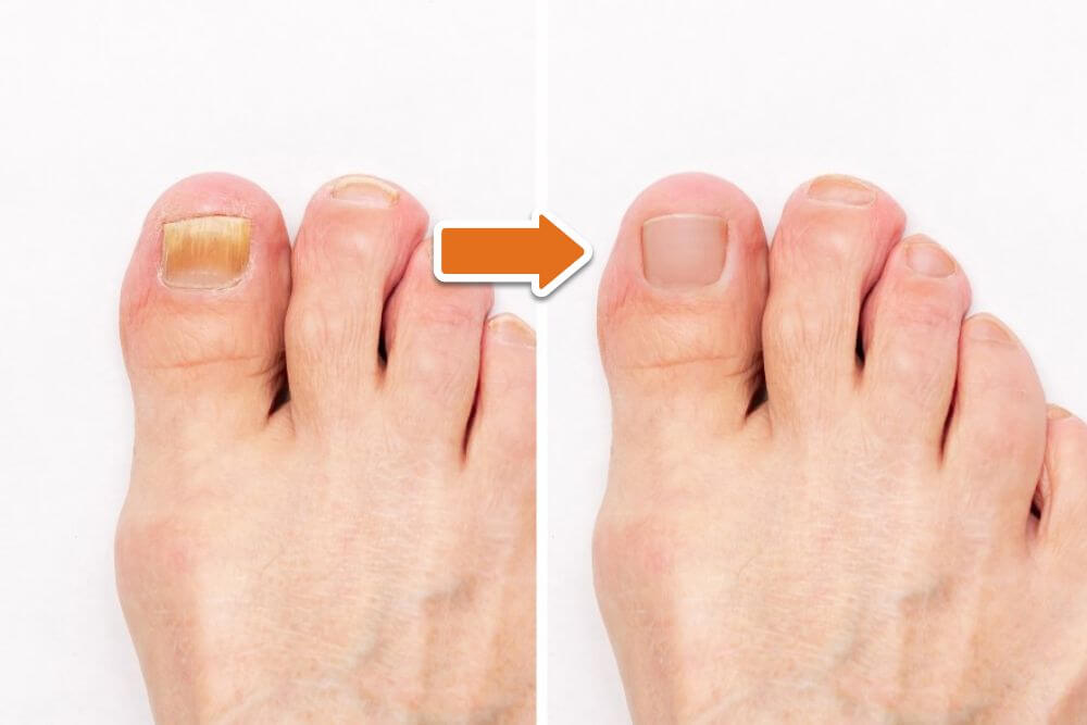 Comparison of toenails before and after treatment, with an arrow indicating improvement.