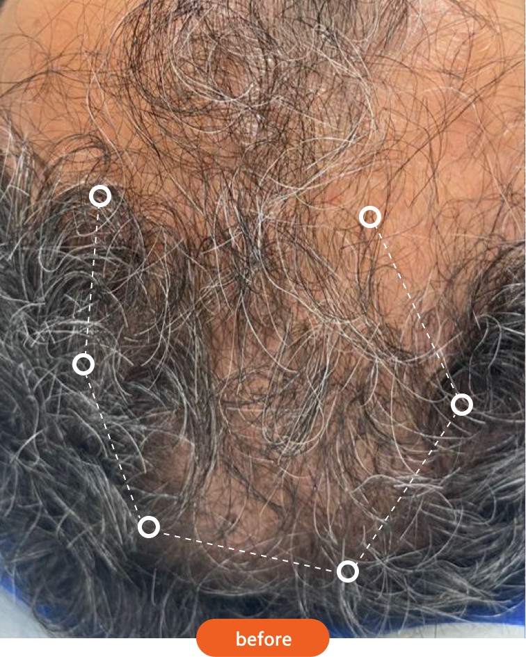 Close-up of a scalp with thinning and graying hair, outlined by a dotted line.