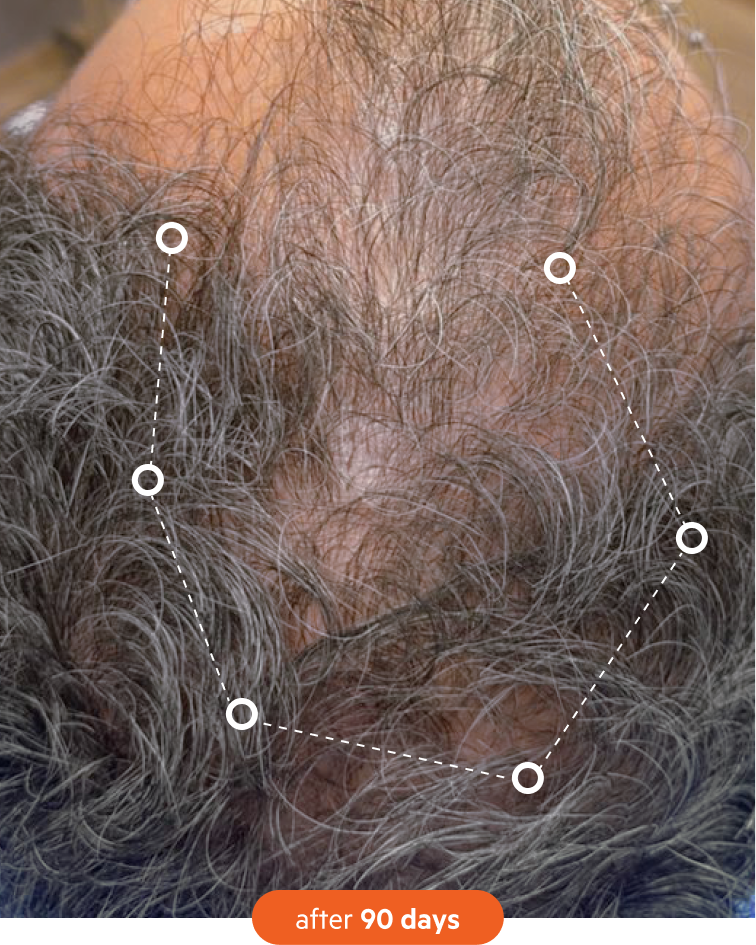 Top view of a person's head showing hair growth and dotted lines.