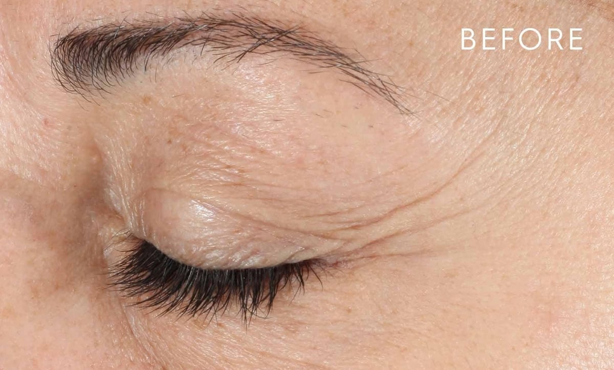 Before: crow&rsquo;s feet and crepiness around the eye