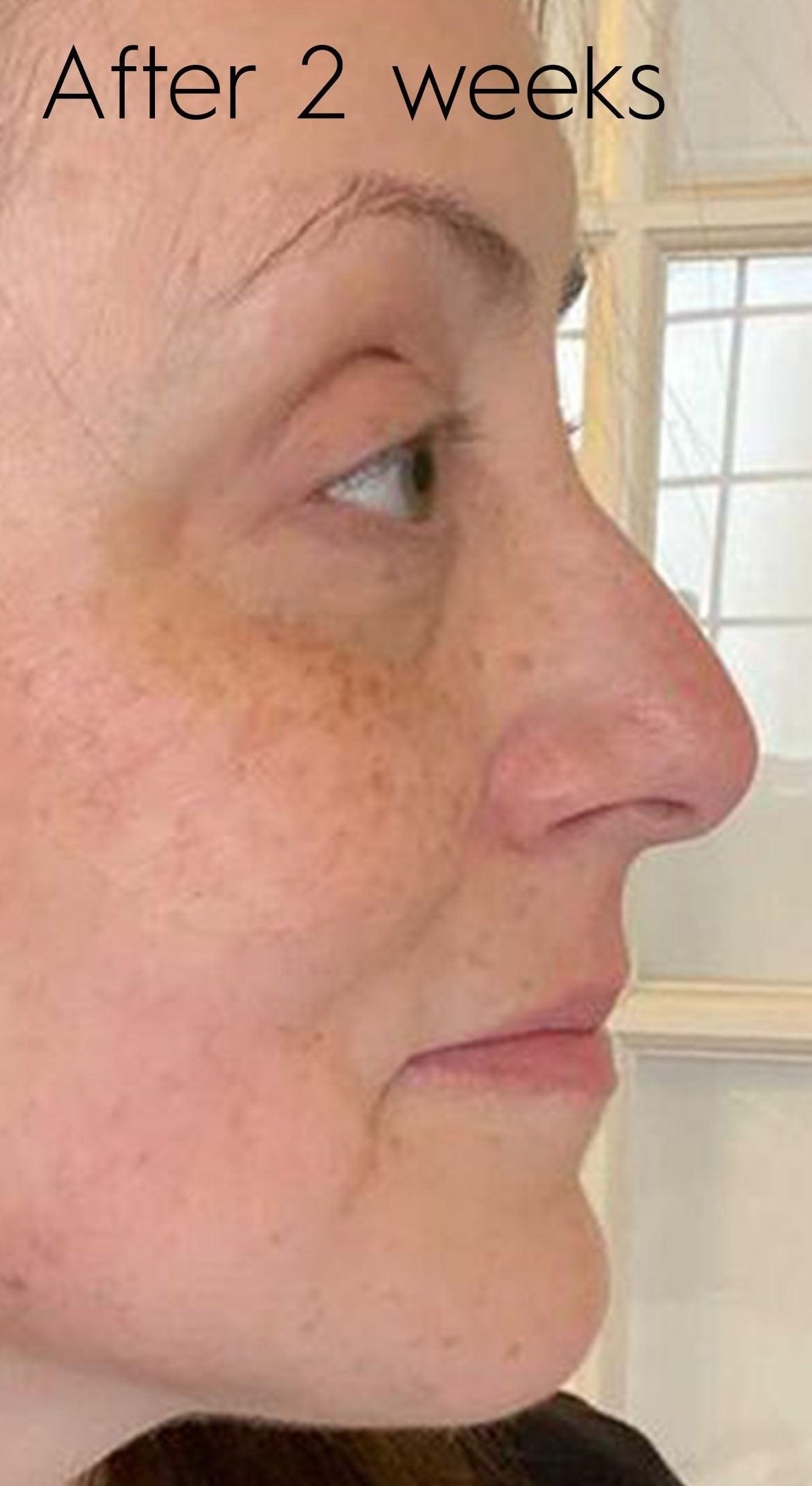 After 14 days of YOUTHFUL Quattro Peptide Serum