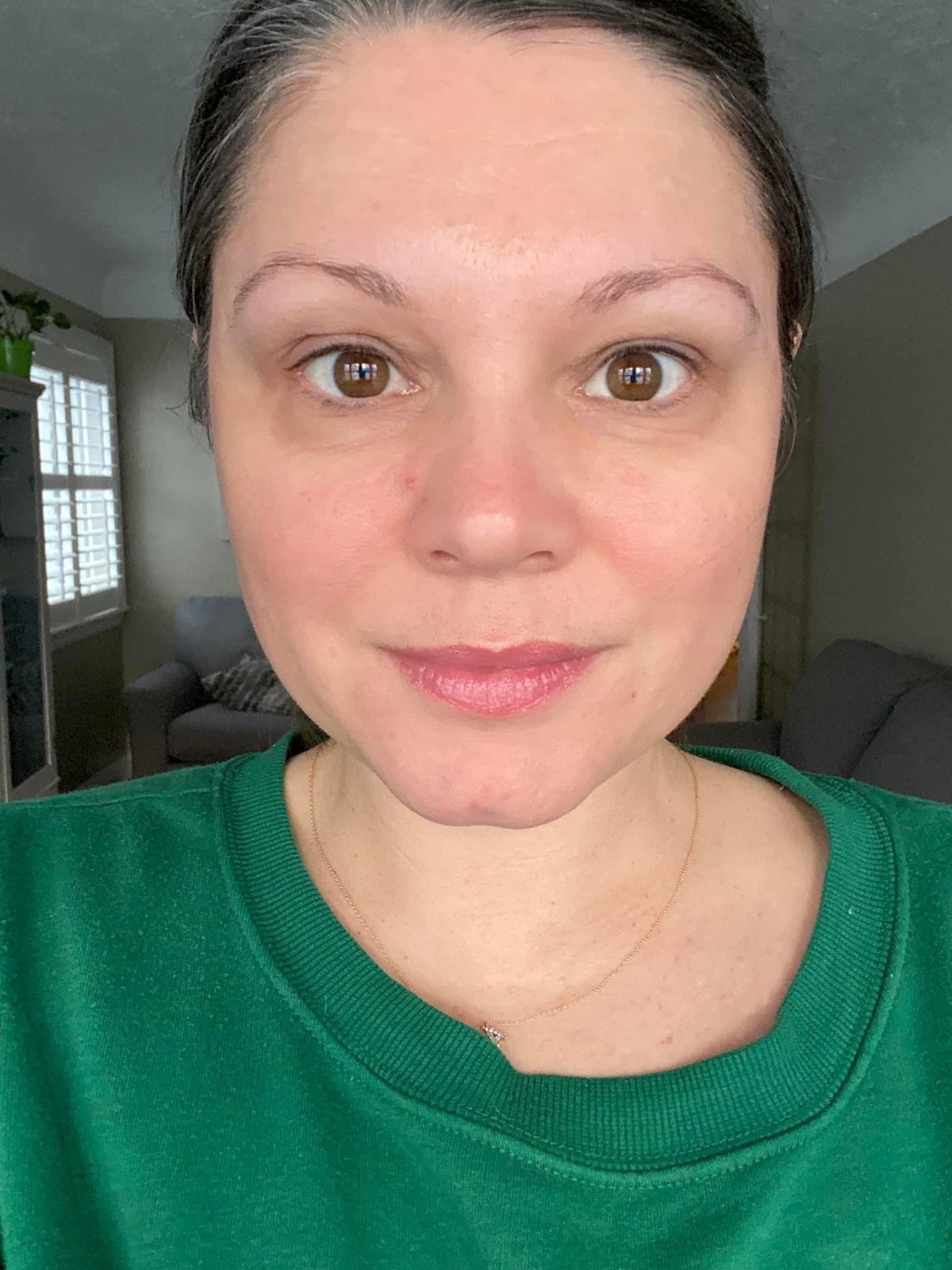 After 28 days of REVEAL Biomimetic Peel Pads