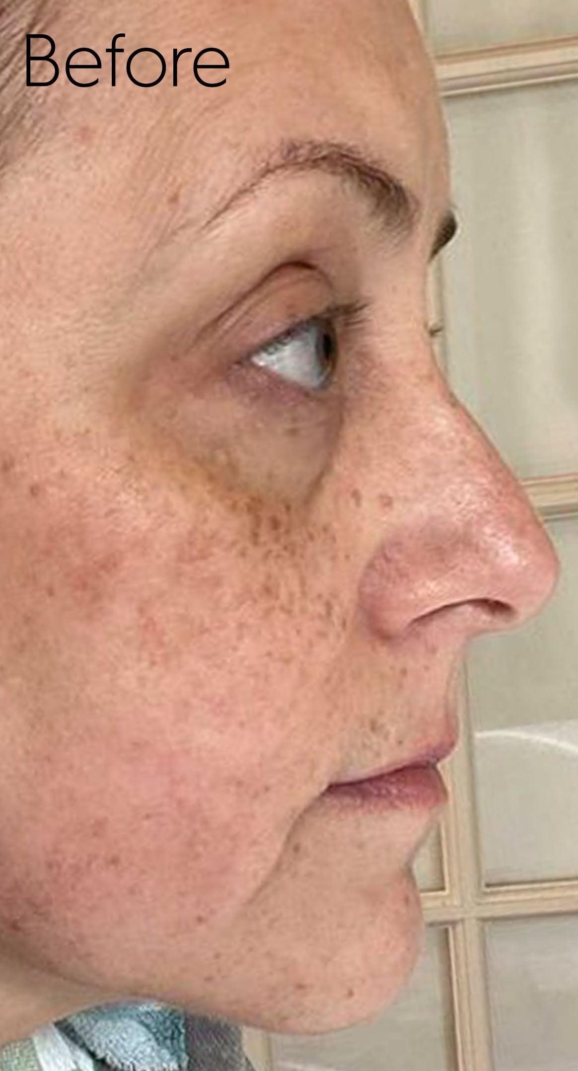 Before: sun spots and uneven tone across the cheek