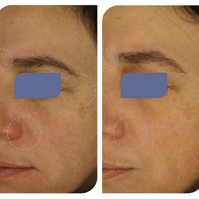 Side-by-side comparison of a face with marked areas, before and after changes.