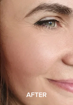 Partial view of a woman's face, smiling, with the word 'AFTER' in white text.