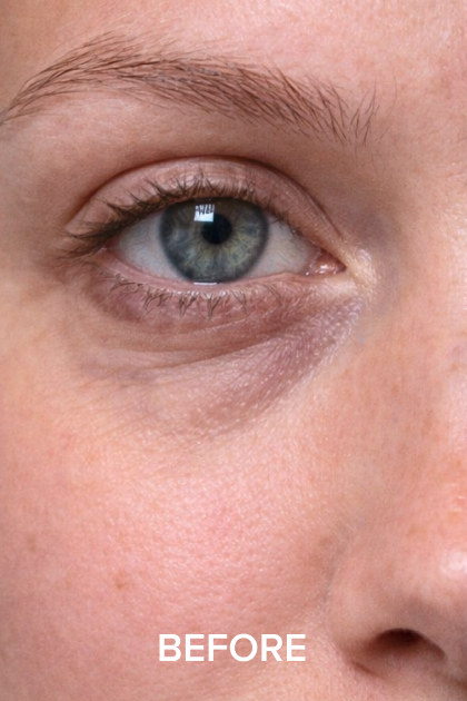 A close-up of a person's eye area showing dark circles and fine lines, with the word 'BEFORE'.