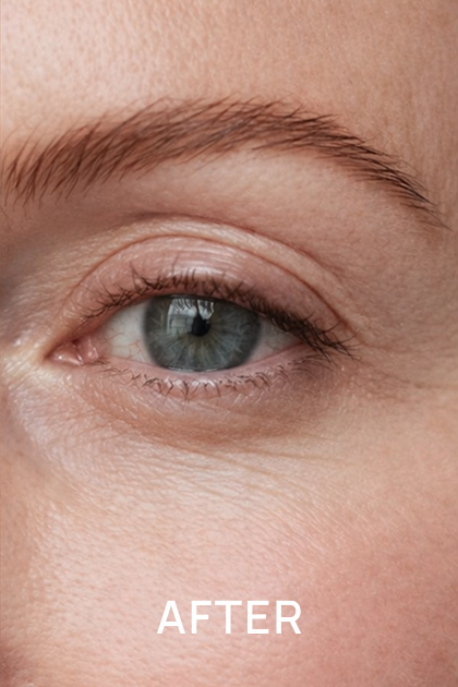 A close-up of a person's eye and the surrounding skin, with the word 'AFTER' written in white.