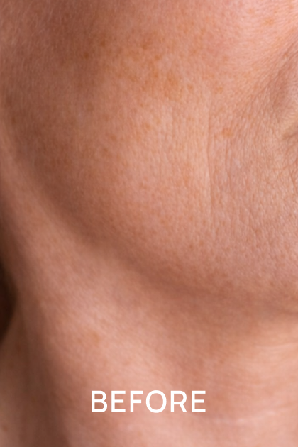 A close-up of skin with fine lines and spots, with the word 'BEFORE' at the bottom.