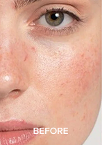 Close-up of a person's face with text 'BEFORE' and visible skin texture.