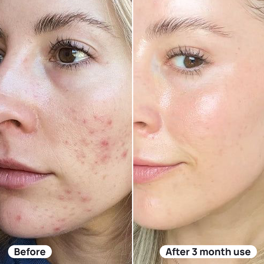A before-and-after image showing a woman's acne significantly reduced after three months of product use.