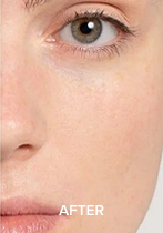 Close-up of a person's eye and part of their face with the word 'AFTER'.