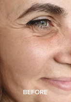 Close-up of a woman's face focusing on the eye and cheek, with 'BEFORE' text.
