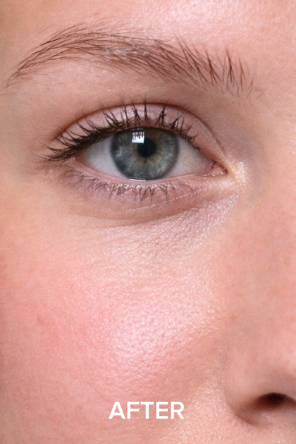 A close-up of a person's eye and cheek, with the word 'AFTER' written at the bottom.