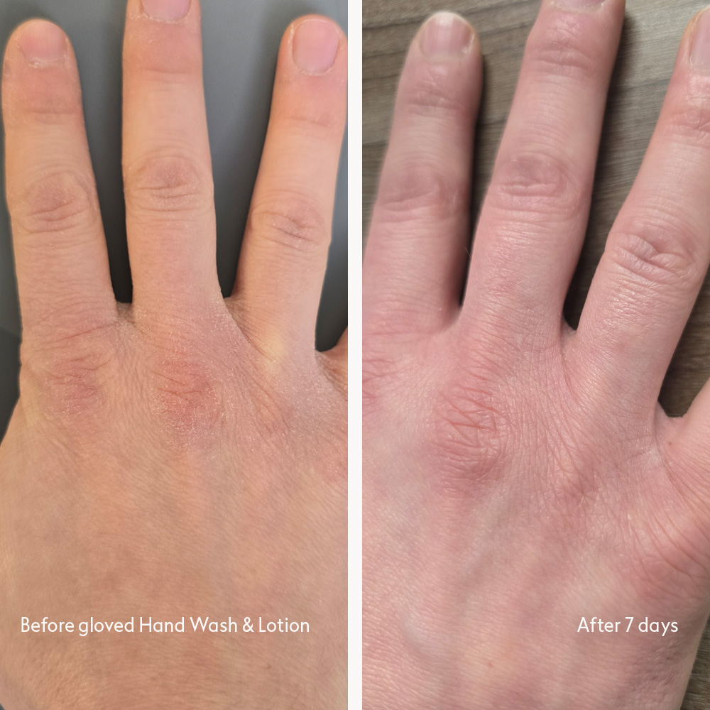 A before and after comparison of a hand, showing dry skin becoming smoother and less red after 7 days.