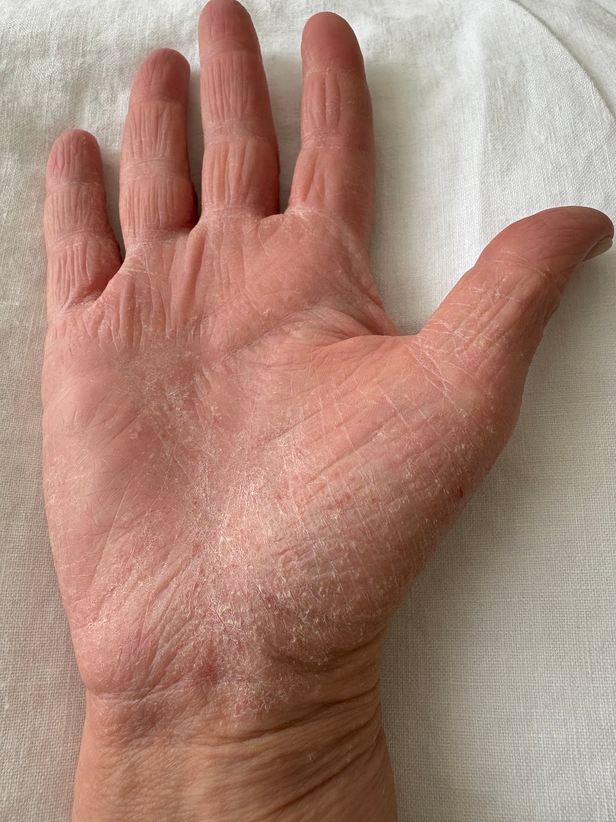 A customer's dry, flaking palm before using gloved