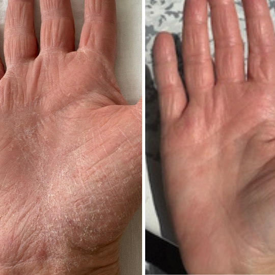 A before and after diptych of a hand, showing the palm changing from dry and flaky to smooth.