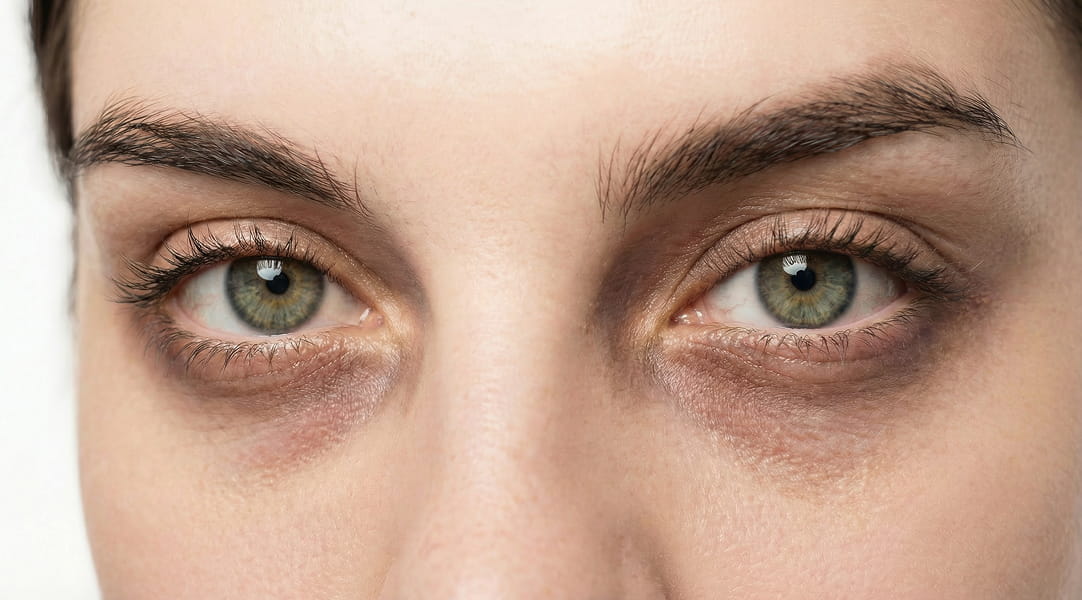 A close-up of a person's green eyes with dark circles underneath them.