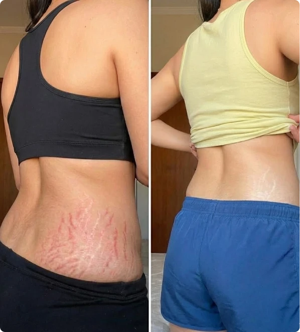 Side-by-side comparison of a person's back showing stretch marks before and after treatment.