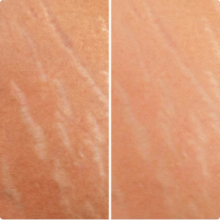 Side-by-side comparison of skin with and without visible marks.