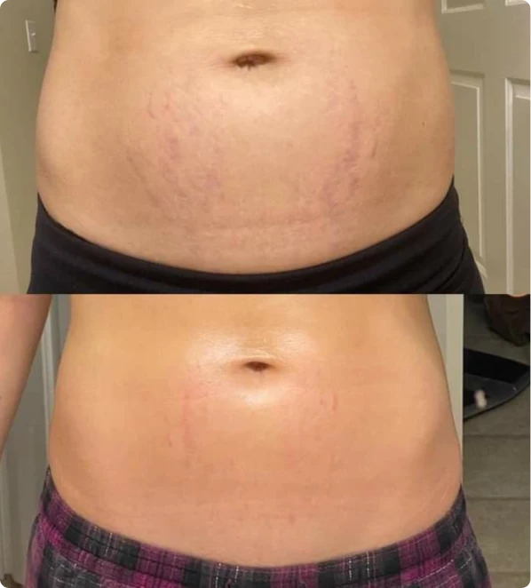 Side-by-side comparison of a belly with stretch marks before and after treatment.